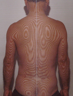 椎間板ヘルニア | モアレトポグラフィー（治療後）